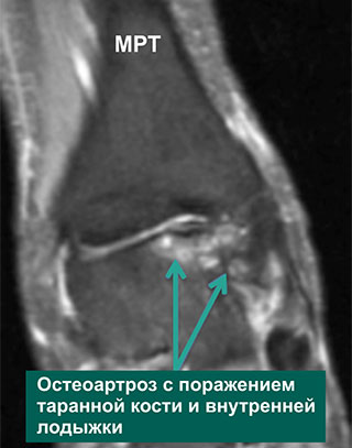 umflarea ligamentului genunchiului