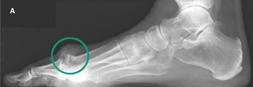Артродез 1-го пальца рентген