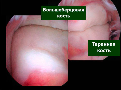 артросокпия голеностопного сустава