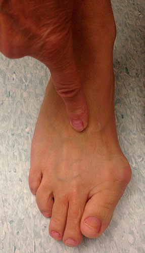 артроз суставов пальцев стопы