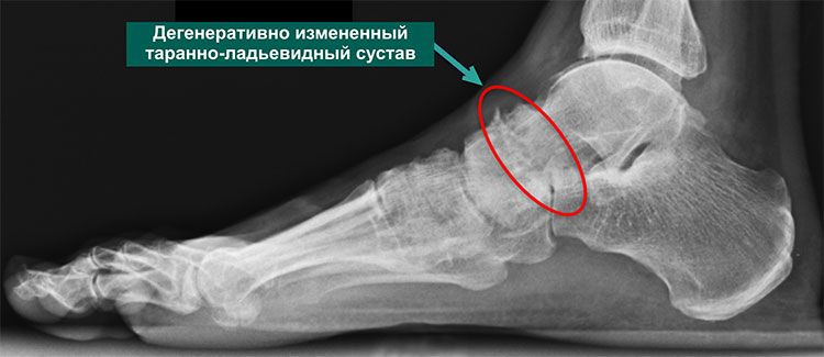 Субхондральный склероз голеностопного. Артроз таранно-ладьевидного сустава рентген. Артроз 2 степени таранно ладьевидного. Ладьевидная кость стопы перелом рентген. Таранно-ладьевидный артроз 1 степени.