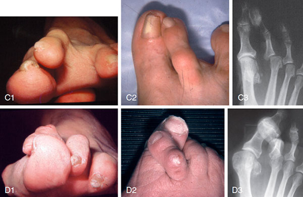 деформация пальцев стопы человека