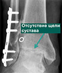 рентген пациента с посттравматическим остеоартрозом