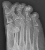 Рентгенограммы стопы когтеобразные пальцы
