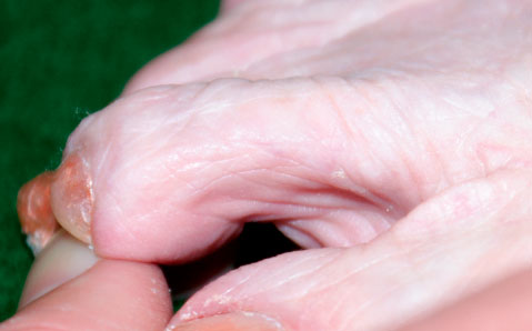 молоточкообразный палец