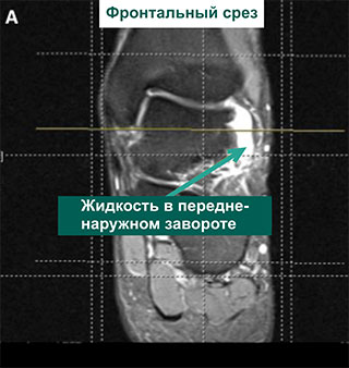 МР-томограммы голеностопного сустава
