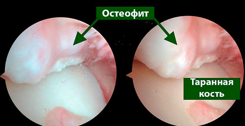 остеофиты голеностопного сустава