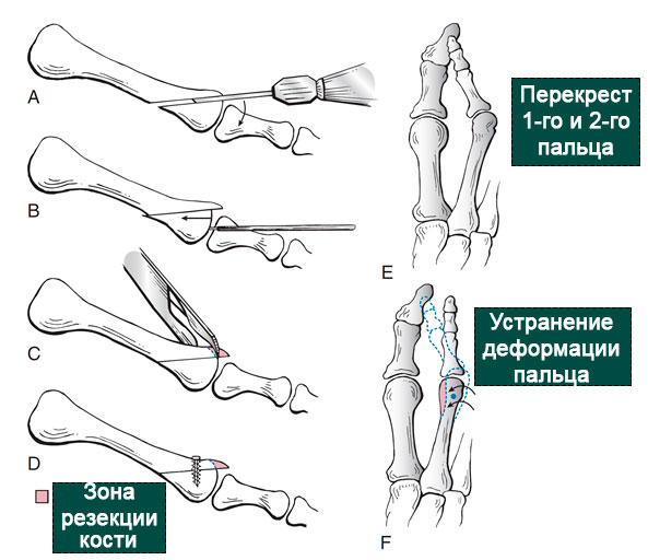 остеотомия weil