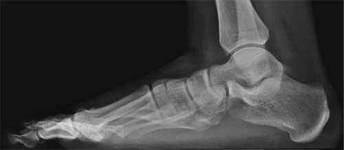 рентгенограмма нормальной стопы