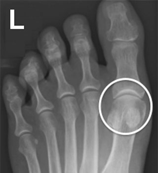 рентгенограмма стопы с вальгусной деформацией 1-го пальца