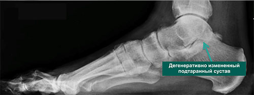 дегенеративно измененный подтаранный сустав