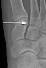 рентген пореждения лисфранка 1-слева