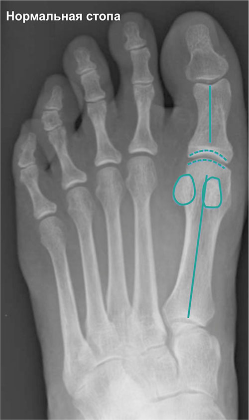 Вальгусная стопа рентген. Сесамовидные кости 1 пальца стопы. Вальгусная деформация кости. Степени вальгусной деформации 1 пальца стопы рентген. Сесамовидные кости 1 пальца стопы рентген.