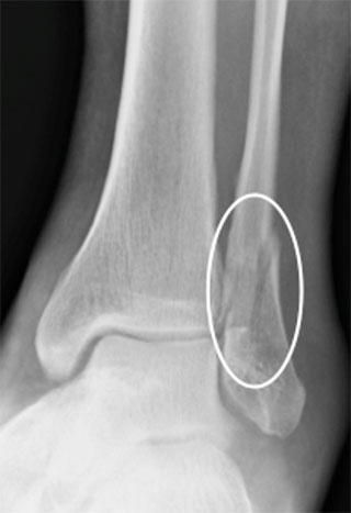 Рентгенограмма перелома наружной лодыжки