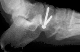 Рентгенограмма после стабилизации перелома