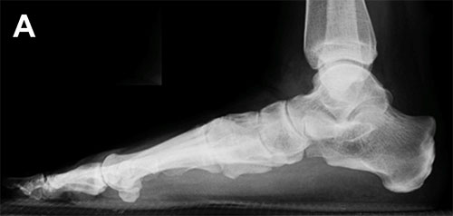 Рентгенограмма нормальных стопы и голеностопного сустава