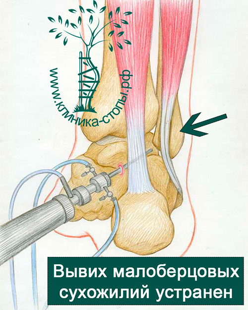 Вывих сухожилий малоберцовых мышц thumbnail