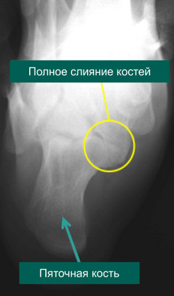 Рентгенограмма стопы с частичной таранно-пяточной коалицией