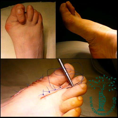 операция по удалению шишек на ногах