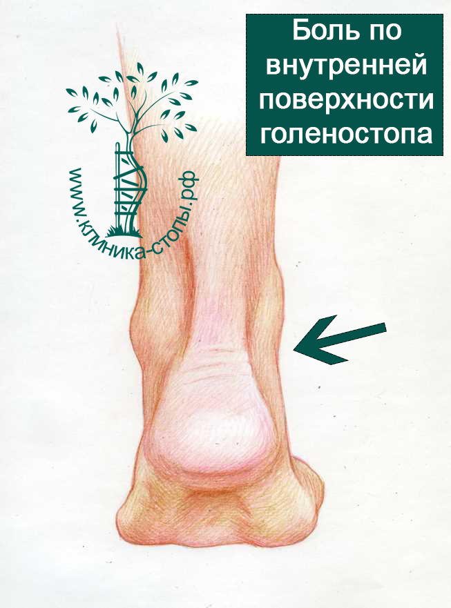 Голеностопный сустав левой ноги