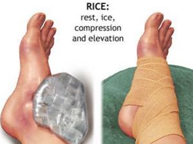 Протокол RICE (покой, лёд, компрессия и возвышенное положение).